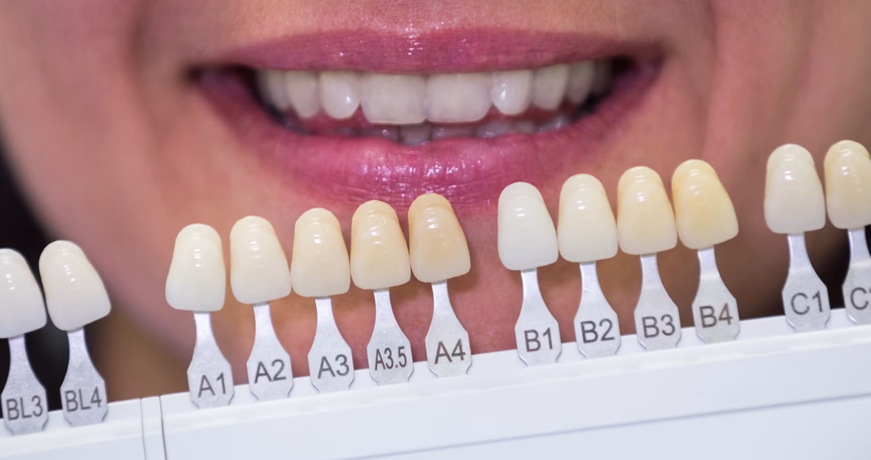 استحکام روکش سرامیکی