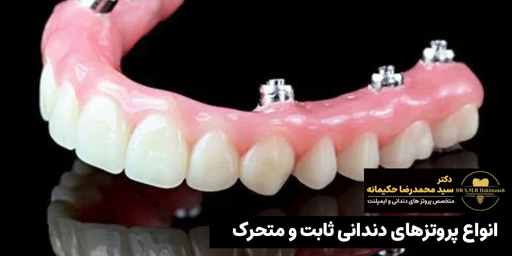 انواع پروتزهای دندانی ثابت و متحرک در اصفهان در مطب دکتر سید محمد رضا حکیمانه