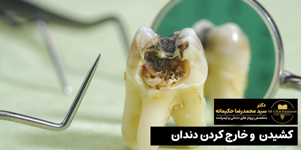خدمات کشیدن دندان در اصفهان
