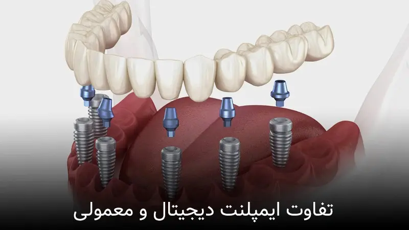 تفاوت انواع ایمپلنت دندان