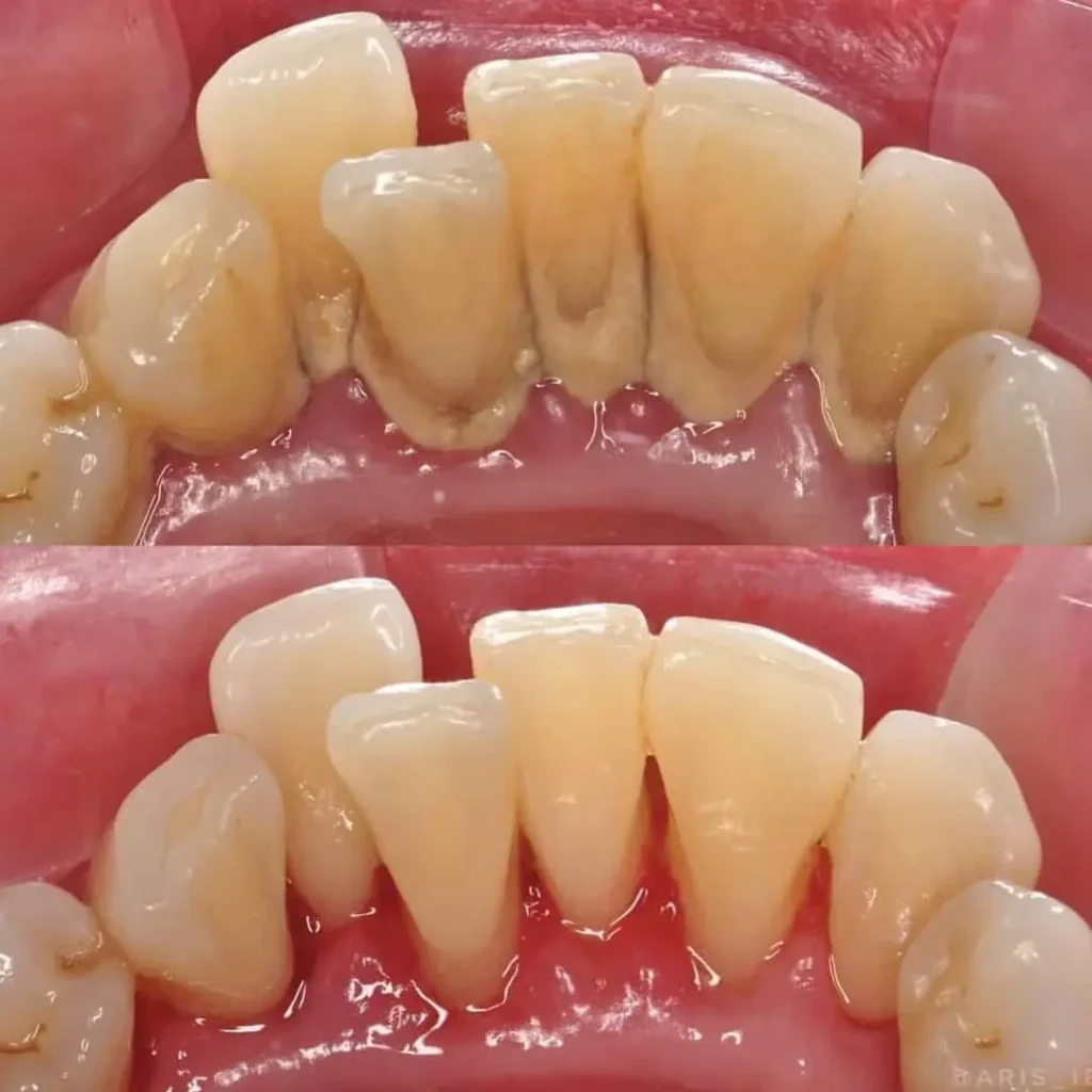مراقبت پس از جرم گیری