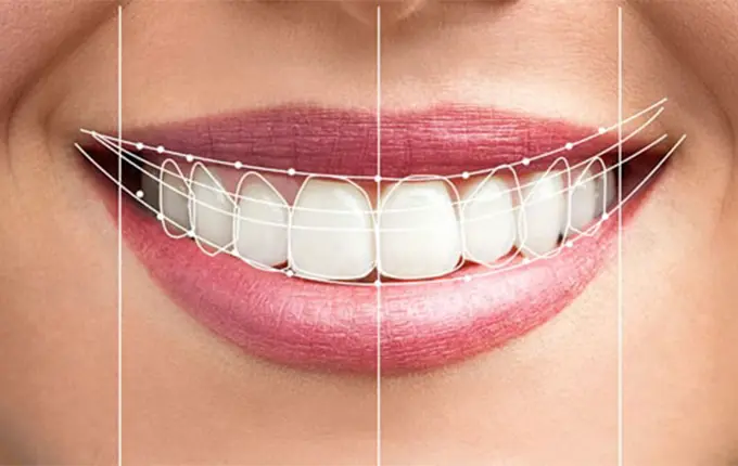 تفاوت اساسی بین لمینت سرامیکی و لمینت کامپوزیتی