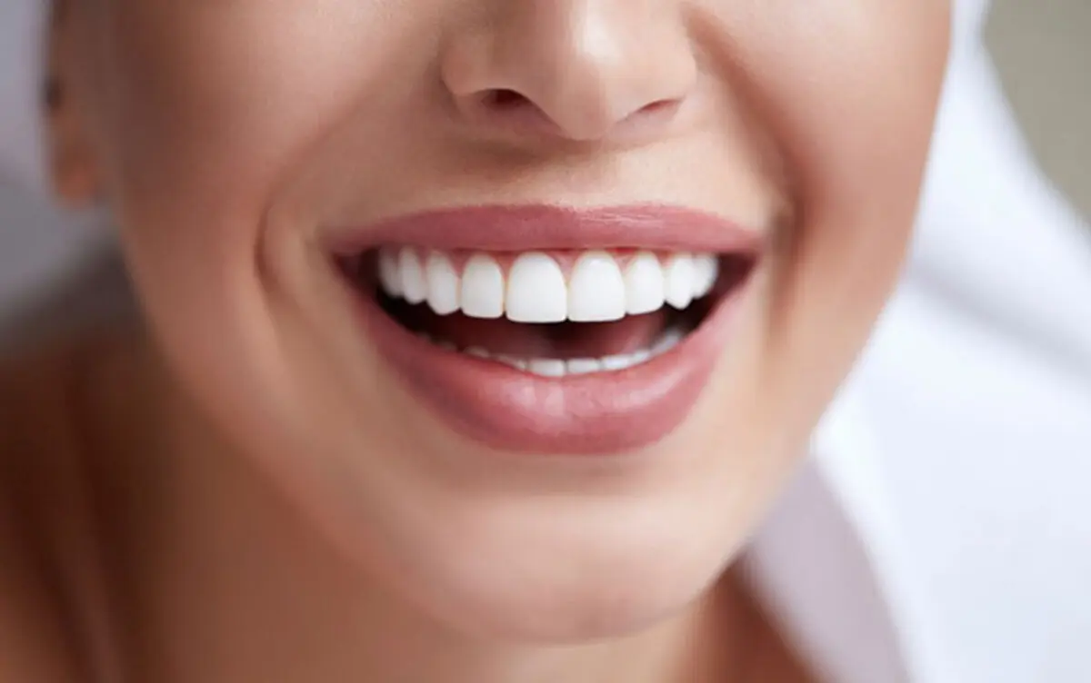 مقایسه لمینت سرامیکی و کامپوزیتی از نظر زیبایی