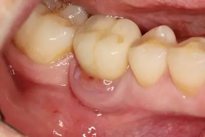 علائم عفونت ایمپلنت دندان
