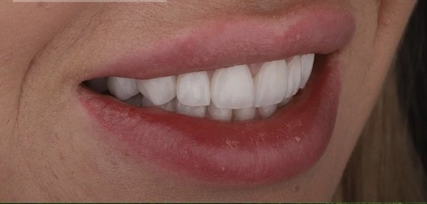 بعد از لمینت سرامیکی