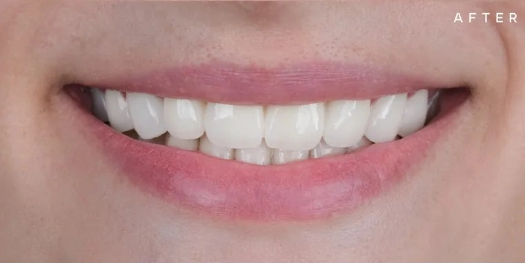 بعد از لمینت