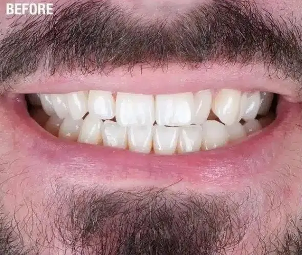 قبل از روکش سرامیکی