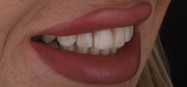 قبل از لمینت سرامیکی