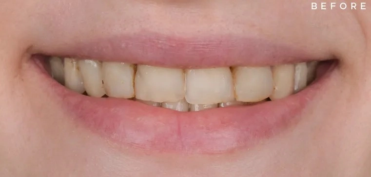 قبل از لمینت