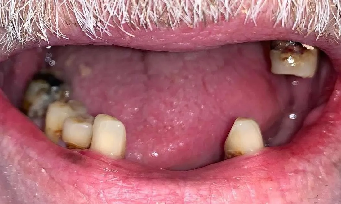 قبل از اوردنچر