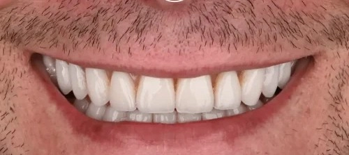 بعد از پروتز ثابت