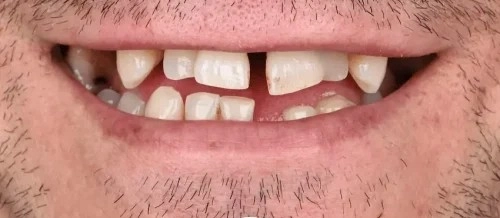 قبل از پروتز ثابت