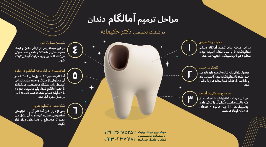 مراحل ترمیم آمالگام دندان