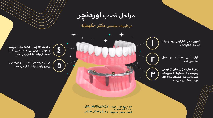 مراحل نصب اوردنچر