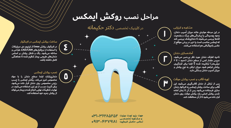 مراحل نصب روکش ایمکس