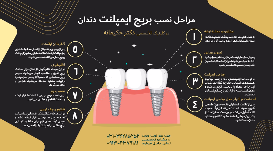 مراحل نصب بریج ایمپلنت دندان