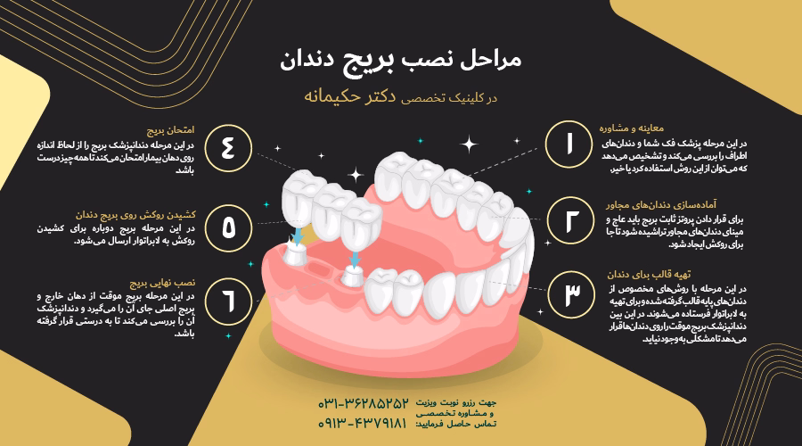 مراحل نصب بریج دندان