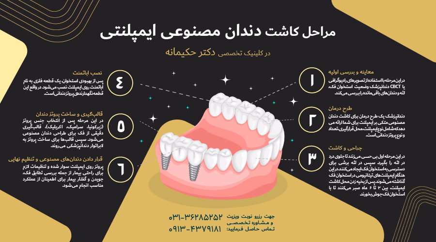 مراحل نصب دندان مصنوعی ایمپلنتی
