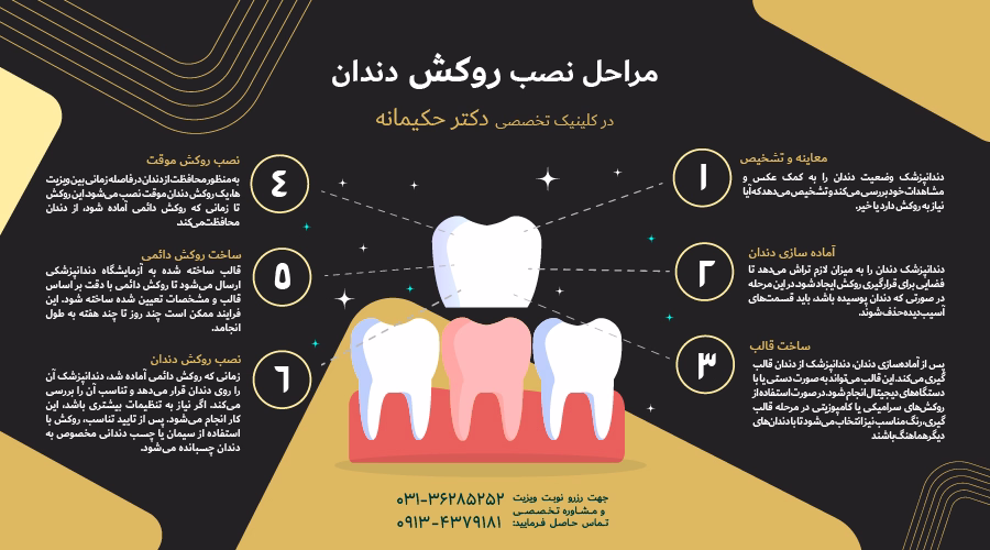 مراحل نصب روکش دندان