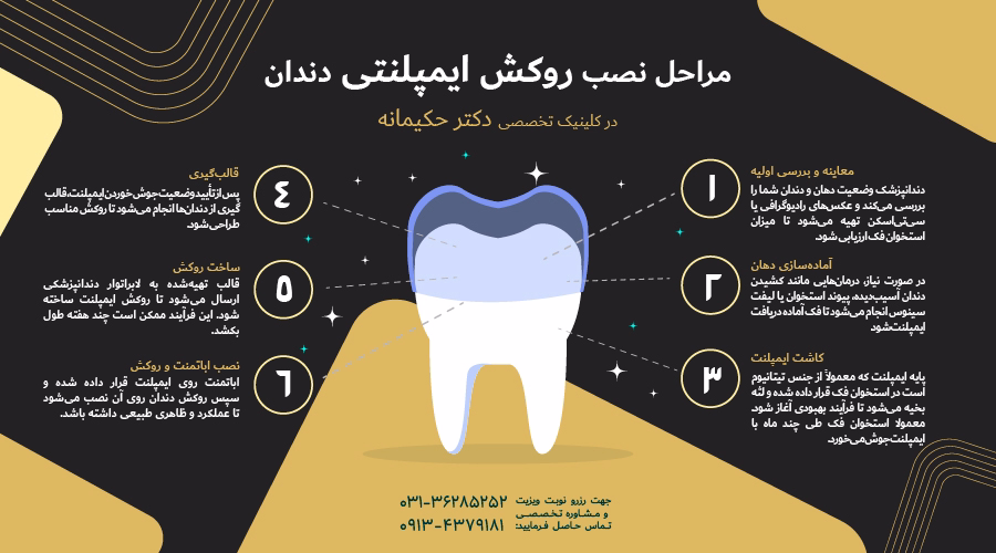 مراحل نصب روکش ایمپلنتی دندان