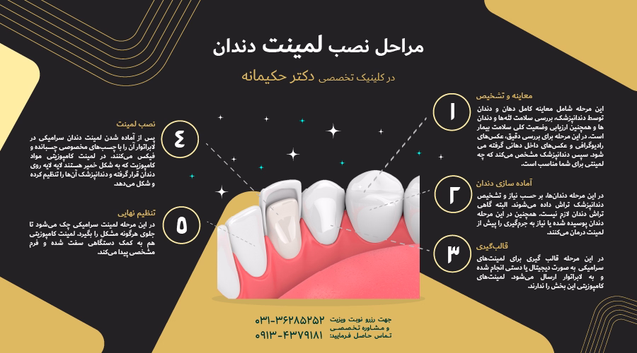 مراحل نصب لمینت دندان