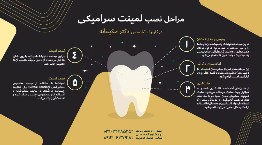 مراحل نصب لمینت سرامیکی