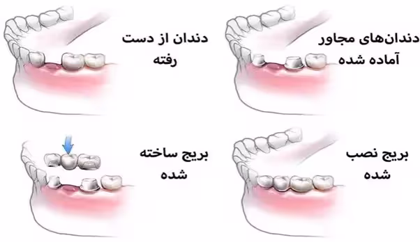 مراحل نصب بریج