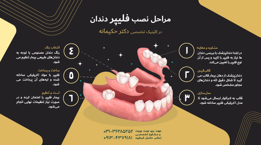 مراحل نصب فلیپر دندان