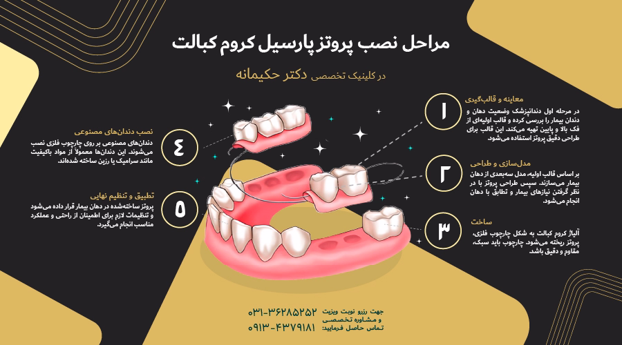 مراحل نصب پروتز پارسیل کروم کبالت
