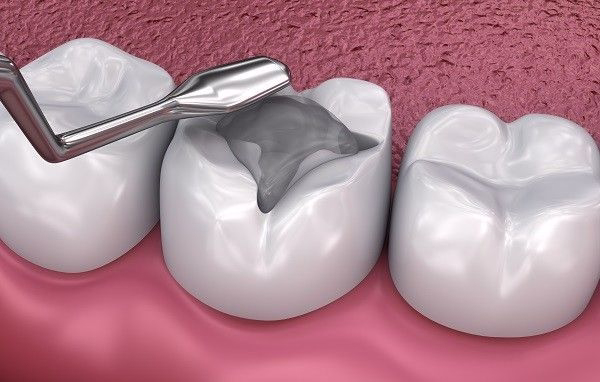 مزایا و معایب ترمیم آمالگام دندان