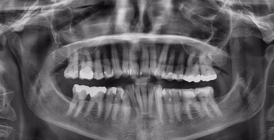 تفاوت عکس CBCT و OPG
