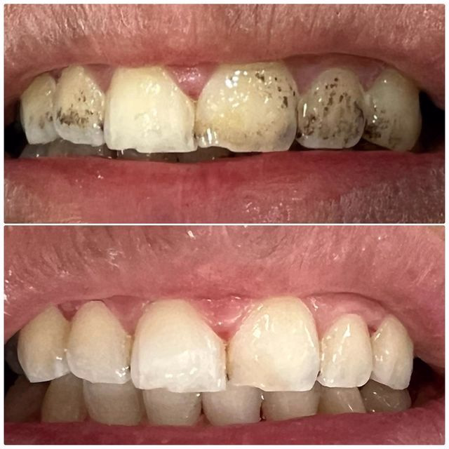 جرمگیری بیماران با لثه حساس
