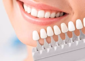 محدودیت های استفاده از روکش سرامیکی