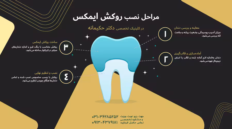 مراحل نصب روکش ایمکس
