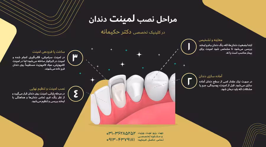 مراحل انجام لمینت دندان
