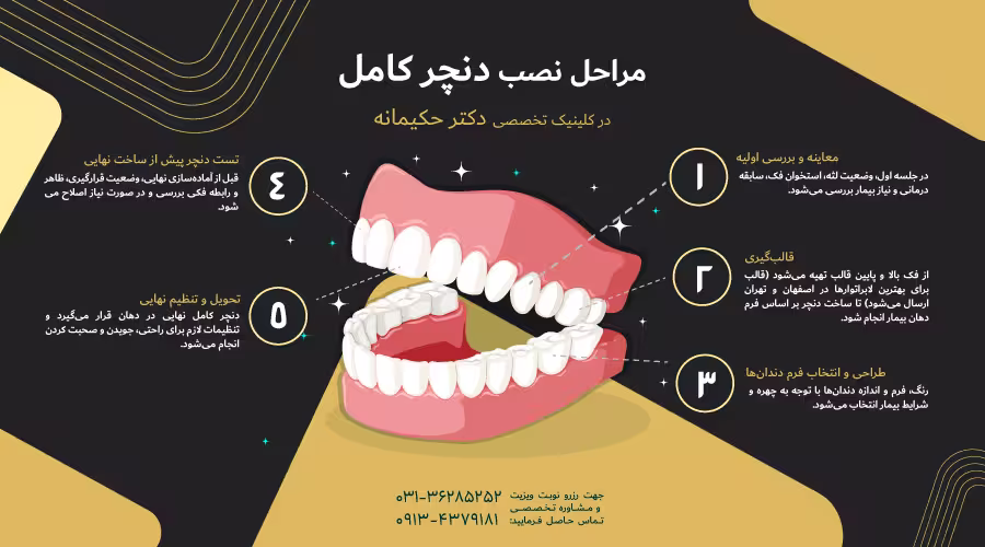 مراحل نصب دنچر کامل