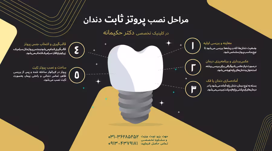مراحل نصب پروتز ثابت دندان