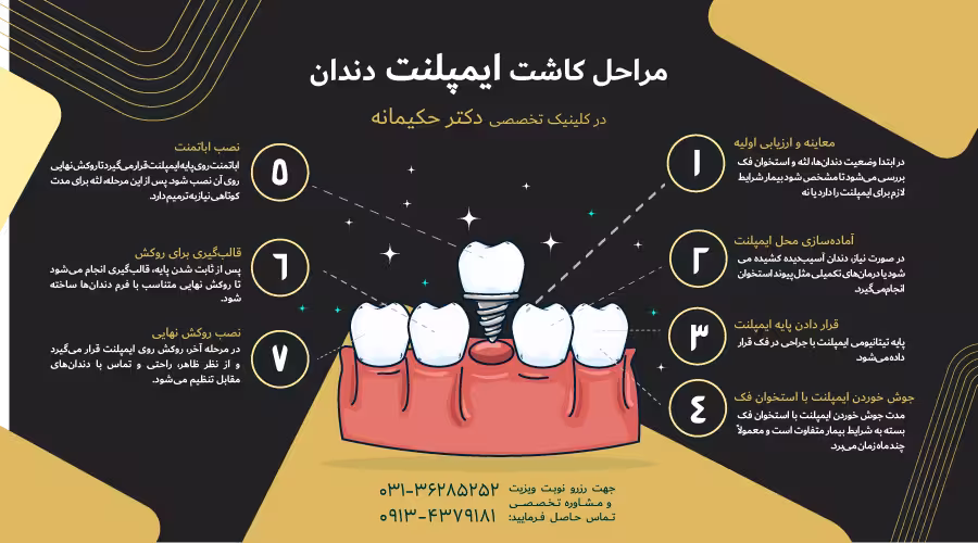 مراحل کاشت ایمپلنت دندان