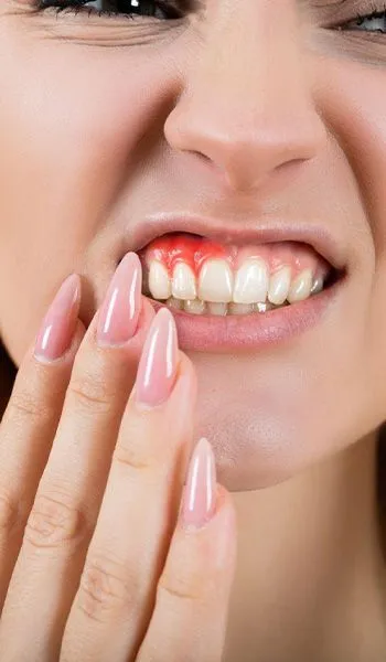 علائم قارچ لثه
