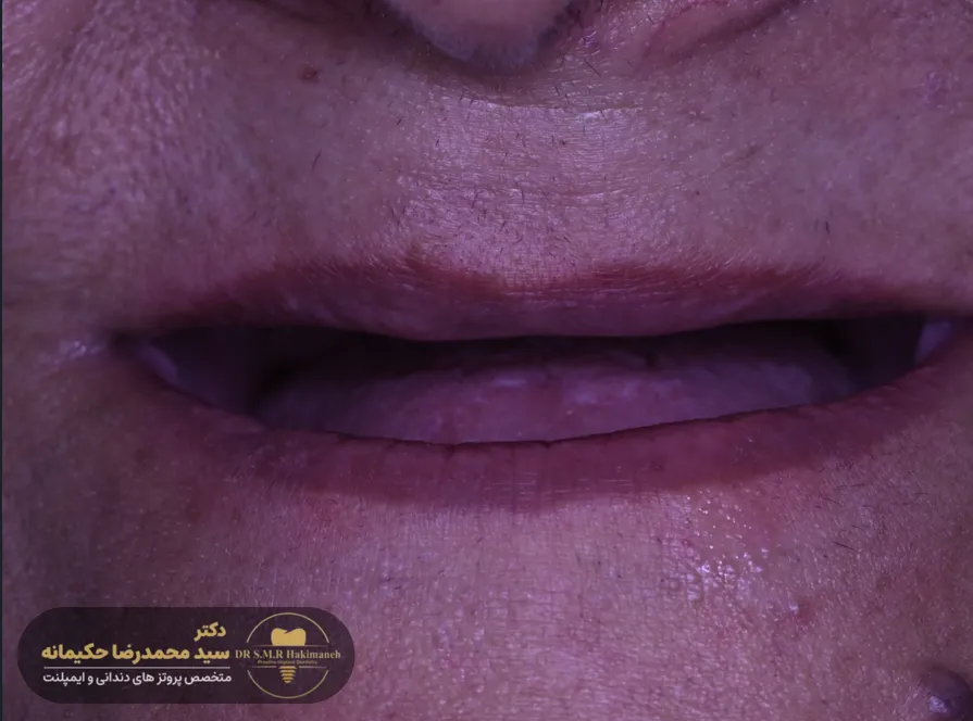 بیمار 13 قبل