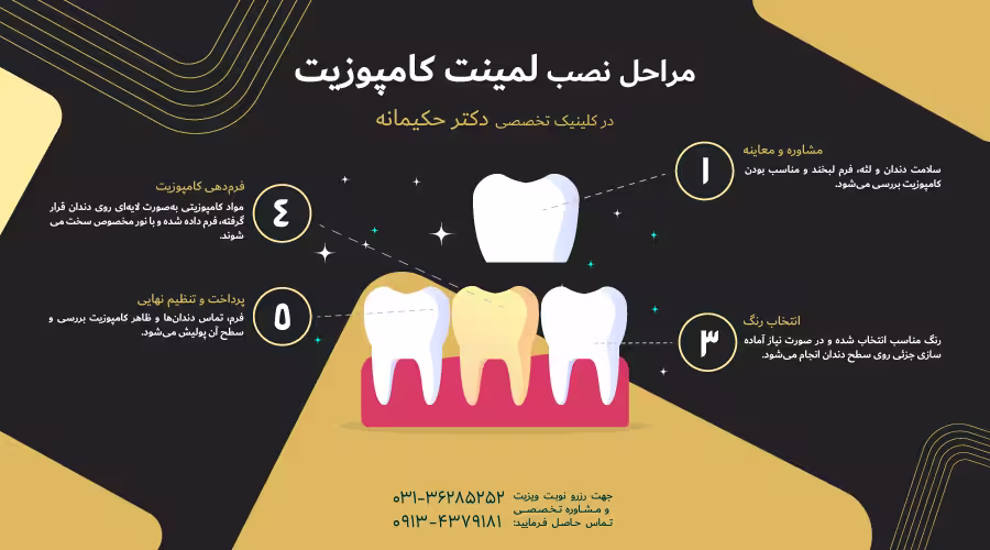 مراحل لمینت کامپوزیت دندان