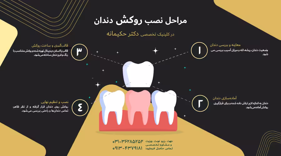 مراحل نصب روکش دندان