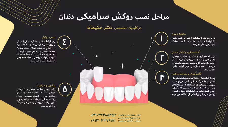 مراحل نصب روکش سرامیکی دندان