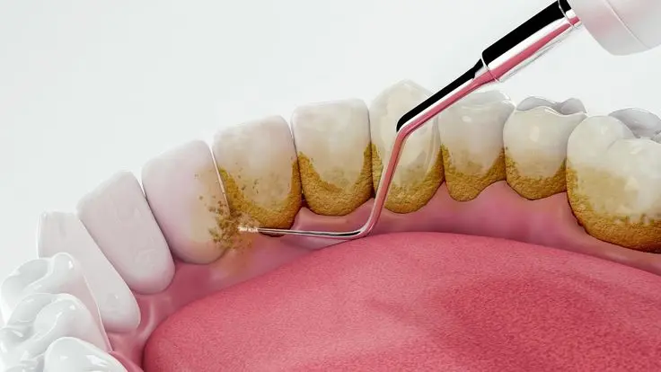 مراحل جرم گیری عمیق دندان چگونه است؟